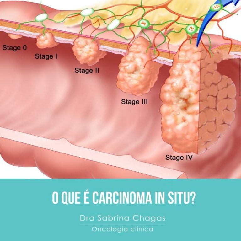 Carcinoma Ductal In Situ Dra Sabrina Chagas