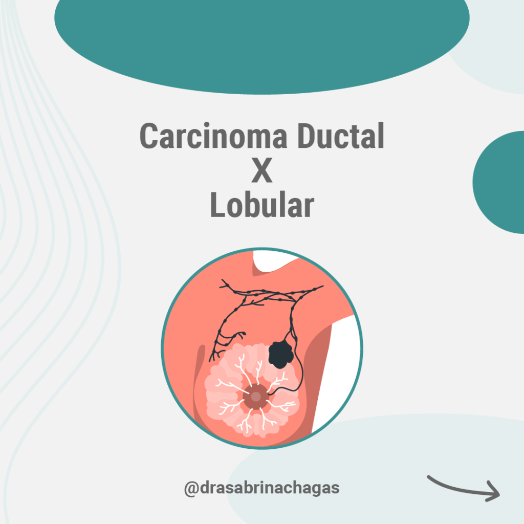 Carcinoma Ductal X Lobular Dra Sabrina Chagas